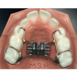 Blue-Wave-Orthodontics-Rye-NY-Darien-CT-Palatal-Expander